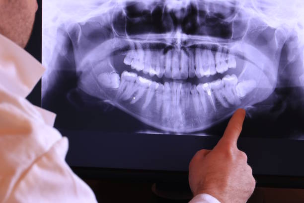 Best Emergency Tooth Extraction in Fort Pierre, SD