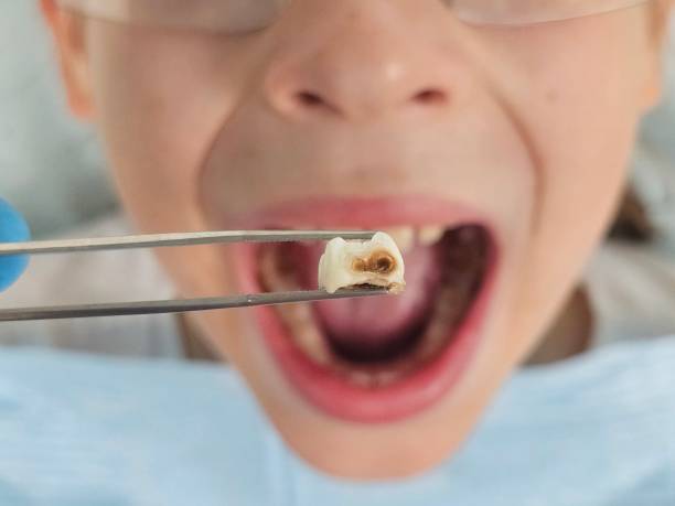 Best Emergency Dental Surgery in Fort Pierre, SD